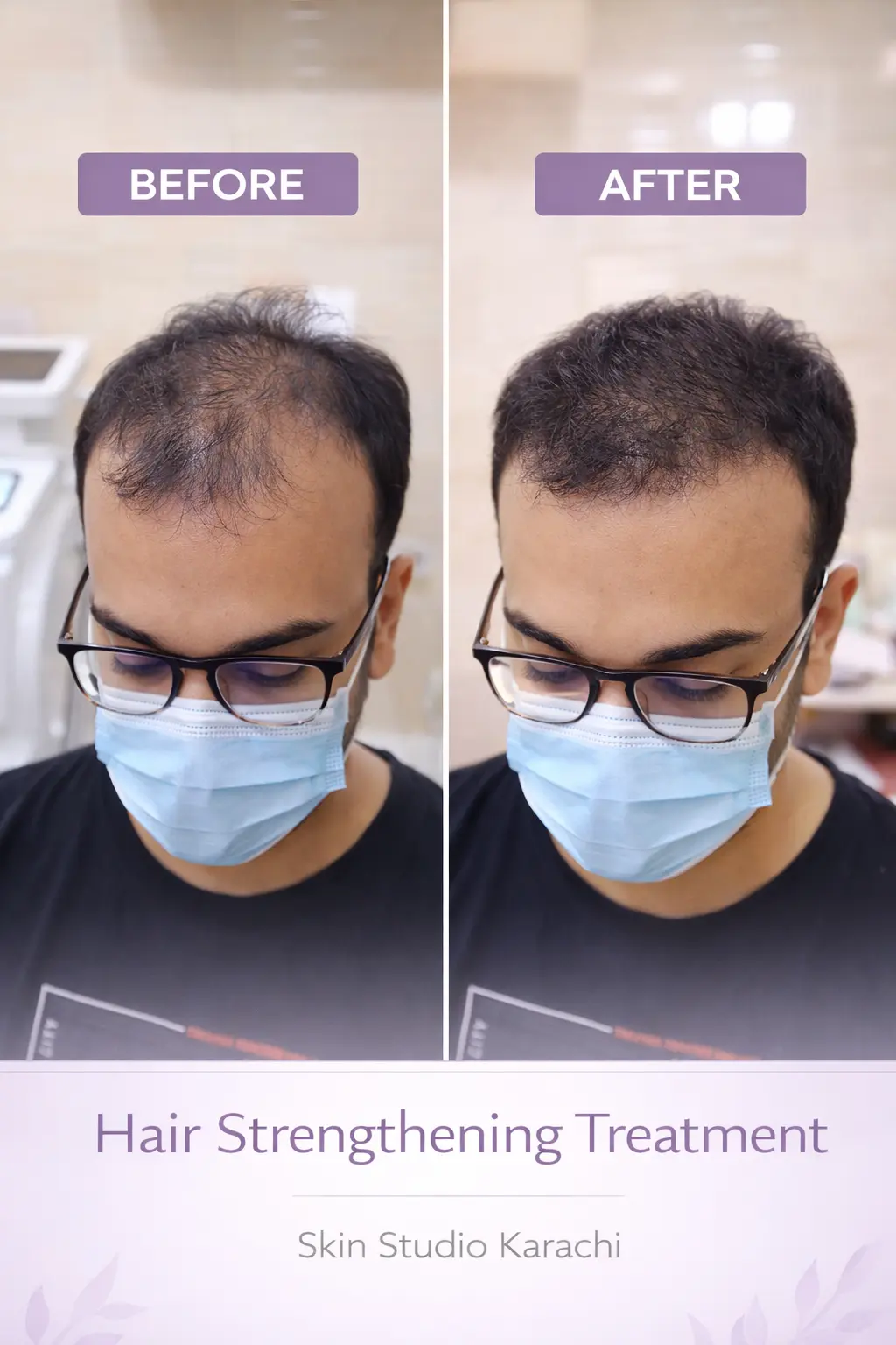 Before and after hair strengthening treatment results in Karachi